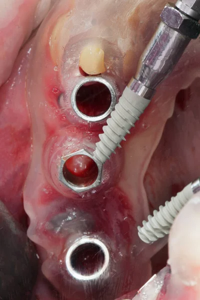 Impianto Dentale Prima Dell Installazione Attraverso Modello Chirurgico Nella Zona — Foto Stock