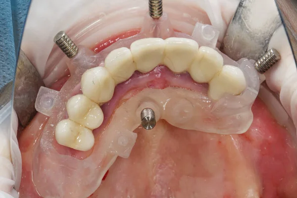 Modello Dentale Chirurgico Nella Cavità Orale Riduzione Dei Denti — Foto Stock