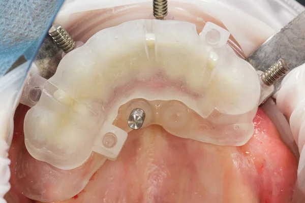 Modello Dentale Chirurgico Pieghevole Nella Cavità Orale Impianto Riduzione — Foto Stock