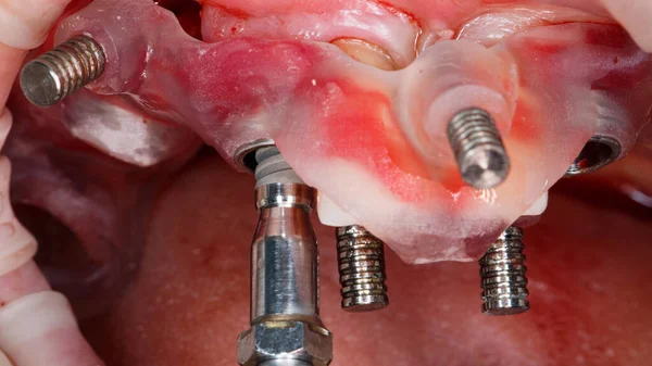 Özel Bir Diş Kalıbı Ile Bir Diş Implantı Yerleştirme — Stok fotoğraf