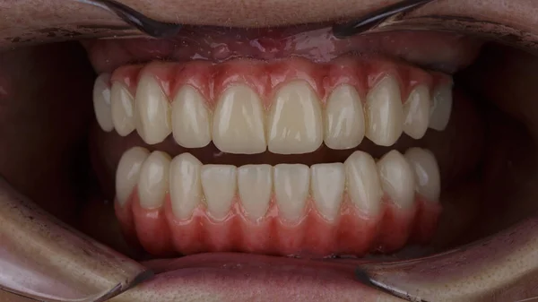 Próteses Dentárias Excelentes Das Mandíbulas Superior Inferior Com Gengivas Artificiais — Fotografia de Stock