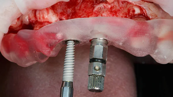 Montaż Drugiego Implantu Obszarze Zębów Centralnych Poprzez Szablon — Zdjęcie stockowe