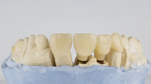 Corona Dental Temporal Para Mandíbula Superior Sobre Modelo Sobre Fondo —  Fotos de Stock
