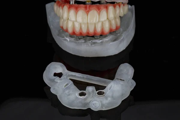 黒の背景に歯科外科用テンプレートと入れ歯 — ストック写真