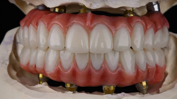 Próteses Dentárias Das Mandíbulas Superior Inferior Zircão Titânio Com Gengivas — Fotografia de Stock