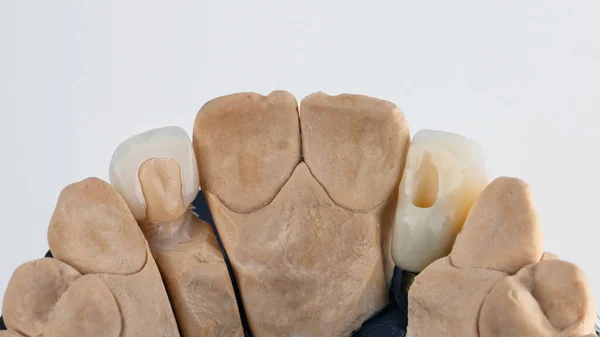 Керамічні Зубні Коронки Молярах Моделі Ззаду — стокове фото