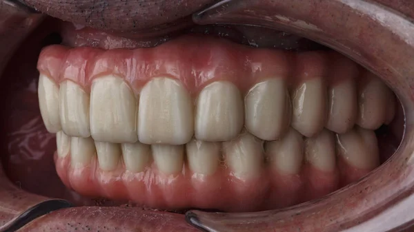Ceramiczne Protezy Zębów Górnej Dolnej Szczęce Ukąszeniu Jamy Ustnej — Zdjęcie stockowe