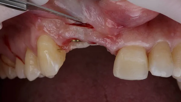 Incisão Gengiva Para Restaurar Volume Gengiva Após Implantação — Fotografia de Stock