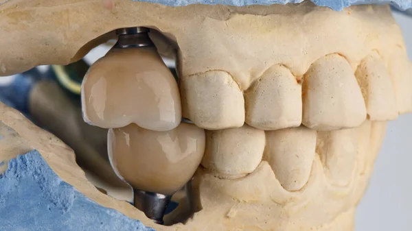 Ceramic Dental Crowns Ceramics Bite Models — Stock Photo, Image