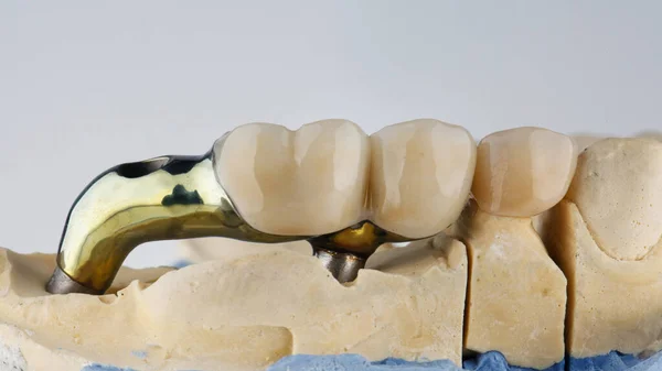 白い背景の模型の上に金色の梁の上にセラミック製の歯冠があります — ストック写真