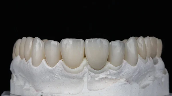 黒を基調とした上顎モデルの優れた歯科用ベンダーとセラミッククラウン — ストック写真