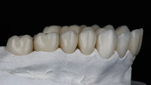 Coroas Cerâmica Dental Área Mastigação Modelo Mandíbula Superior Fundo Preto — Fotografia de Stock