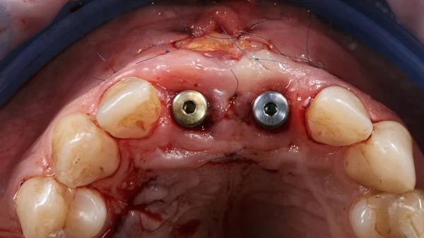 Implantes Dentales Instalados Formadores Encías Región Los Dientes Centrales —  Fotos de Stock