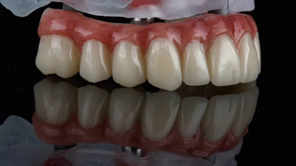 Ângulo Bonito Uma Prótese Dentária Com Gengivas Artificiais Tomadas Vidro — Fotografia de Stock