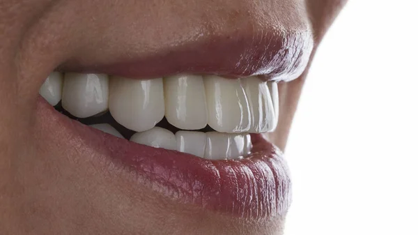 Senyum Besar Seorang Gadis Dengan Veneers Dan Tekstur Giginya — Stok Foto