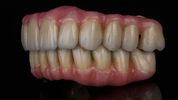 口の中の上顎と下顎のセラミック歯科補綴物反射して黒いガラスに — ストック写真