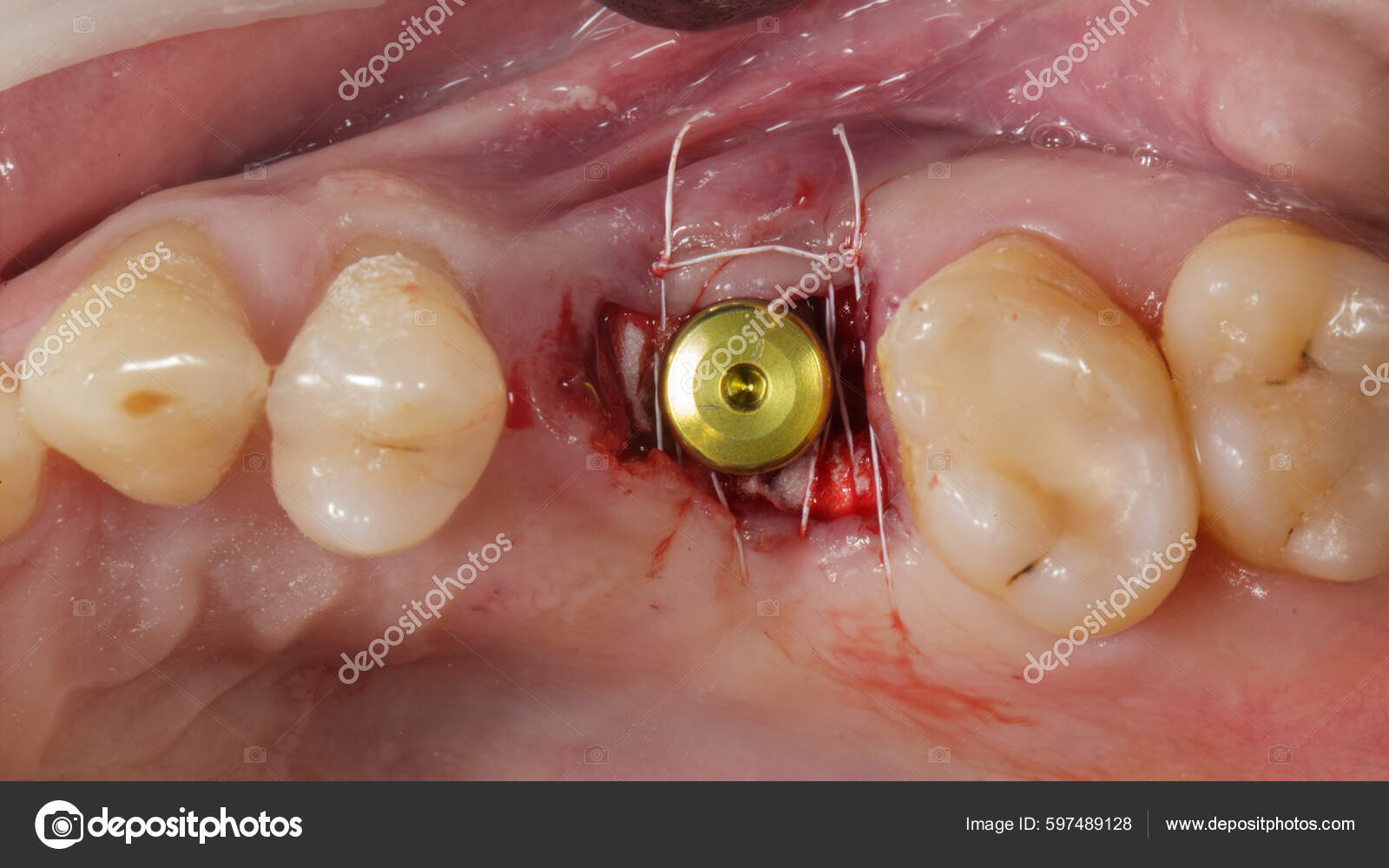 Excellent View Sutured Gingiva Gingiva Former Implant Installed Stock