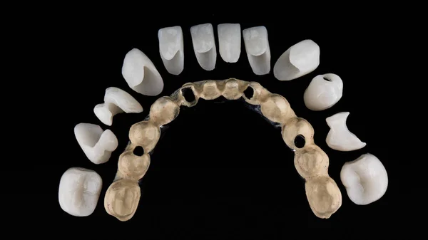 Beautifully Arranged Ceramic Crowns Titanium Bar Prosthesis Top View Black —  Fotos de Stock