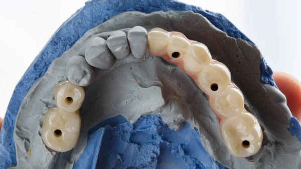dental bridge prosthesis and zircon crowns in the chewing area on a plaster model