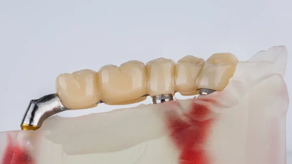 dental bridge prosthesis on a model on a beam on a white background