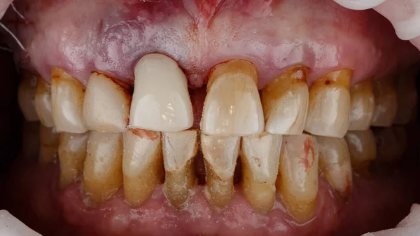 Temporary Crown Central Tooth Orthopedics Implantation — Fotografia de Stock