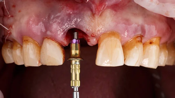 surgical dental moment of installation of the abutment in the area of the central tooth after implantation