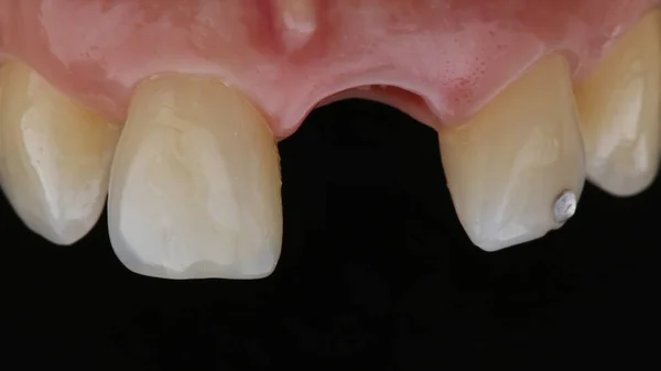 Dental Macro Photo Missing Central Tooth Implantation — ストック写真