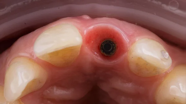 Macro Dental Photo Mirror Abutment Central Tooth Implantation — Stockfoto