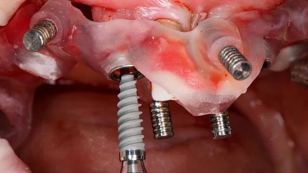 Great Moment Inserting Dental Implant Special Dental Template Implantation — Foto Stock