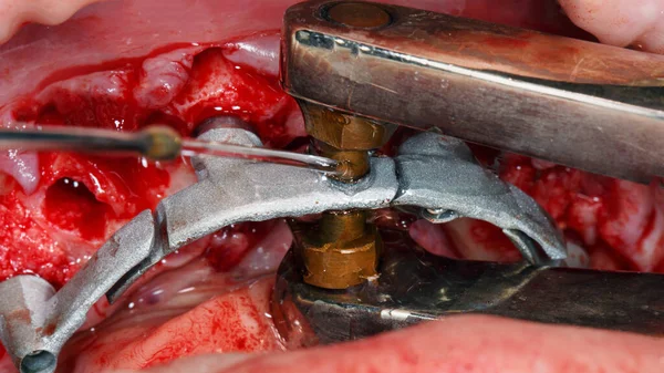 Intraoral Dental Welding Cobalt Chromium Bar Implantation — Foto Stock