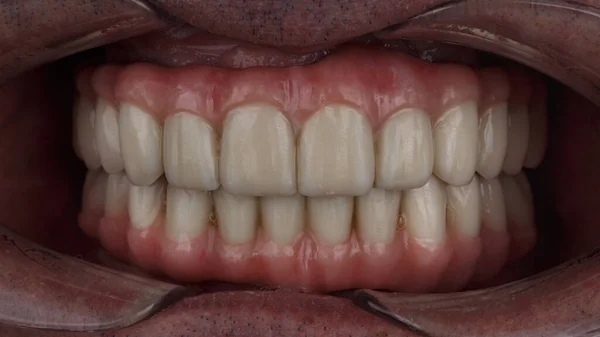 Dental Prostheses Made Ceramics Titanium Bite Upper Lower Jaws Excellent — Foto de Stock