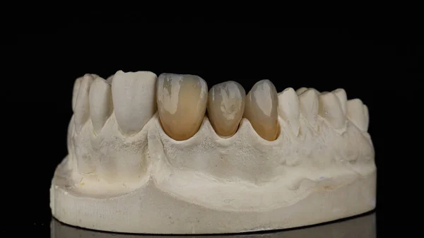 three ceramic dental veneers of yellow natural shade of teeth on a beautiful plaster model on a black background