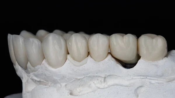 Beautiful Dental Crowns Made Ceramics Model Upper Jaw Black Background — Stockfoto