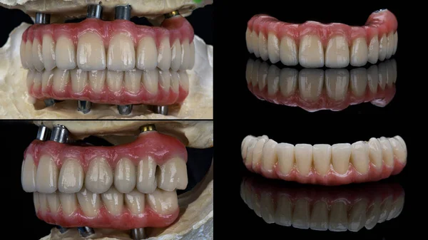 Dental Collage Ceramic Titanium Prostheses Models Black Background — Fotografia de Stock