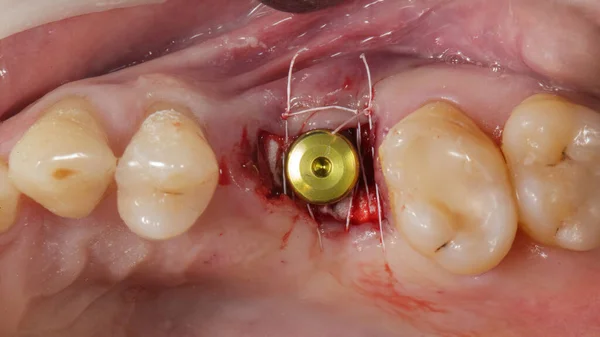 Excellent View Sutured Gingiva Gingiva Former Implant Installed — Photo