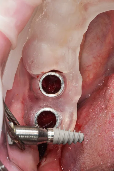 Surgical Dental Template Short Implant Insertion Bone — Foto Stock