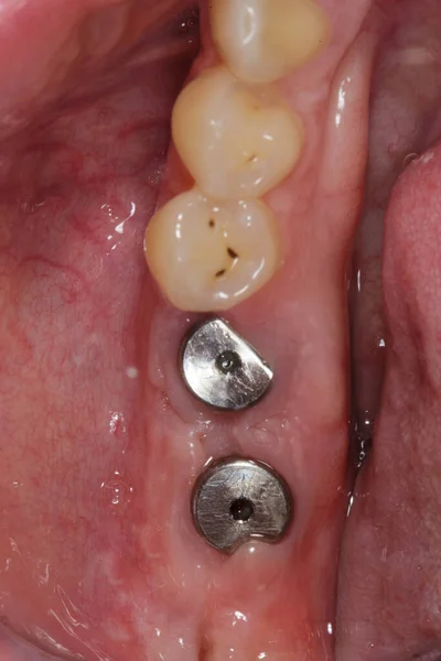 Επουλωθεί Ουλίτιδα Δύο Gingiva Formers Μετά Την Εμφύτευση — Φωτογραφία Αρχείου