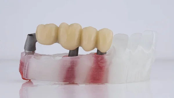 Temporary Dental Bridge Prosthesis Four Teeth Bar White Background — Foto de Stock