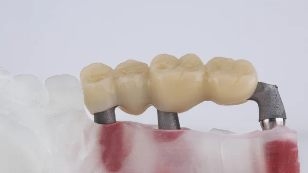temporary dental bridge prosthesis for four teeth on the beam from the inside on a white background