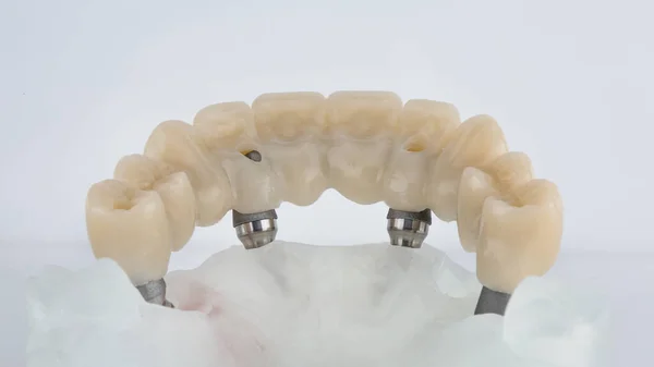 Upper Jaw Prosthesis Morphology Teeth Model Filmed White Background — Foto de Stock
