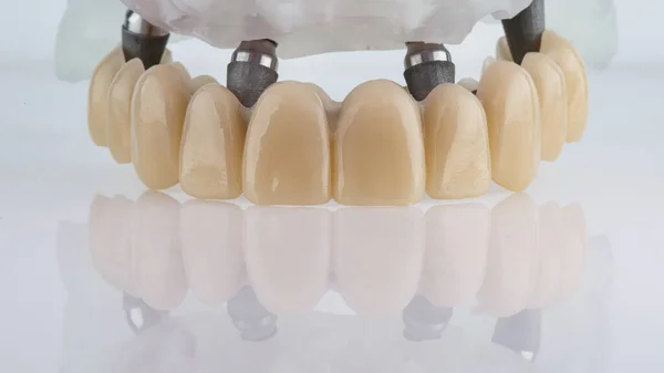 Perfect Angle Dental Prosthesis Upper Jaw White Background Creative Reflection — Stock Photo, Image