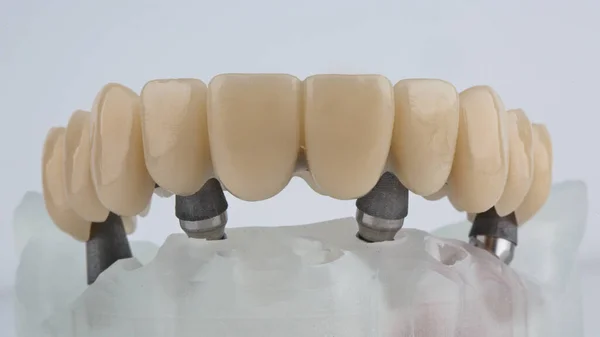Excellent Dental Prosthesis Upper Jaw Large Teeth Bar Model Shot — Foto de Stock