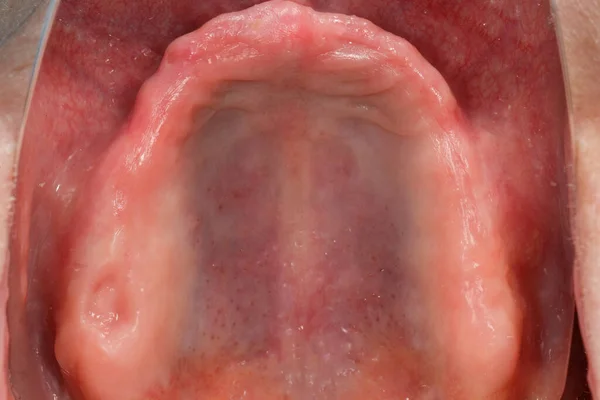 Edentulous Upper Jaw Perfect Gingiva Implantation Seen Mirror — Stock fotografie
