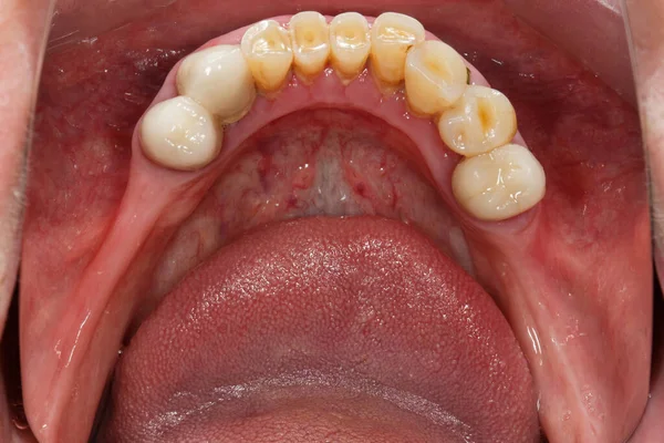 Lower Jaw Teeth Implantation View Mirror — ストック写真