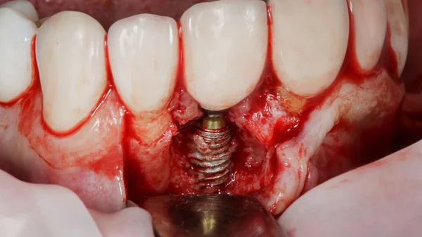 Εγκατεστημένο Γυμνό Οδοντικό Εμφύτευμα Του Κεντρικού Δοντιού Πριν Την Εμφύτευση — Φωτογραφία Αρχείου