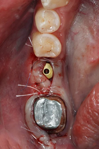 Sutured Gingiva Gingiva Former Posterior Tooth Implantation — ストック写真