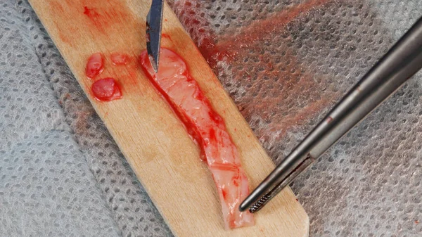 Soft Tissue Graft Flap Implantation Gum Dental Implantation Surgery Fotos de stock