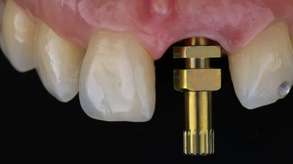 Dental Macro Photo Analog Transfer Central Tooth Installing Crown Imagen de stock
