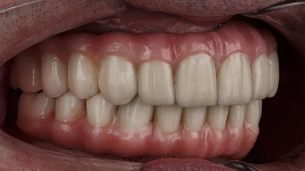 Side View Dental Prostheses Made Ceramics Bite Upper Lower Jaws Fotos de stock libres de derechos