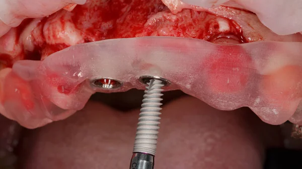 Moment Installation Dental Implant Surgical Template Imágenes de stock libres de derechos